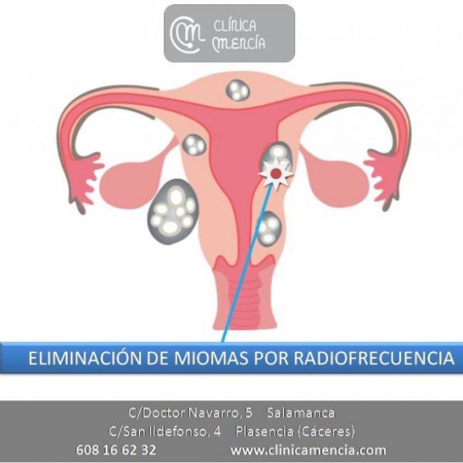 eliminacion miomas radiofrecuencia